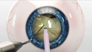 Cataract Surgery Finevision Triumf Trifocal IOL implantation Katarakt Cerrahisi Trifokal Lens [upl. by Jeremias]