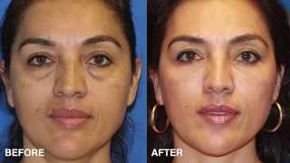 Facial Plastic Surgeon Explains How to Take 10 Years off your Eyes With Surgery blepharoplasty [upl. by Ros804]