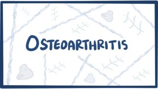 Osteoarthritis  causes symptoms diagnosis treatment amp pathology [upl. by Decima864]