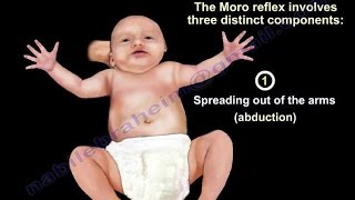 Moro Reflex  Everything You Need To Know  Dr Nabil Ebraheim [upl. by Corly]