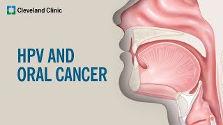 What Is HPVRelated Oral Cancer [upl. by Kling13]