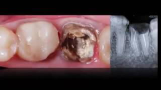 Tooth autotransplantation [upl. by Etteraj766]