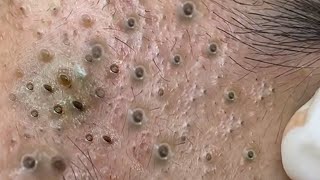 Big Cystic Acne Blackheads Extraction Blackheads amp Milia Whiteheads Removal Pimple Popping  4021 [upl. by Bernette]