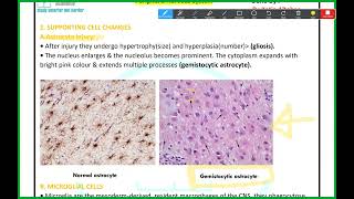 PNS Pathology Demyelinating disease of the CNS Mutah [upl. by Ayotna]