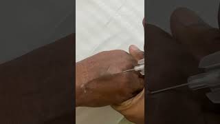 IV cannula insertiondocternursingmotivationviralvideoshortvideo [upl. by Bowden874]