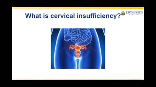 Treatment of Cervical Insufficiency [upl. by Adnocahs]