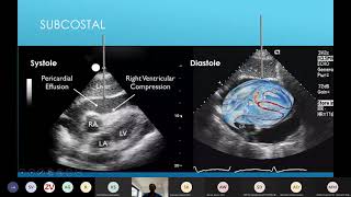 21 04 13 Pericardiocentesis lecture [upl. by Martijn128]