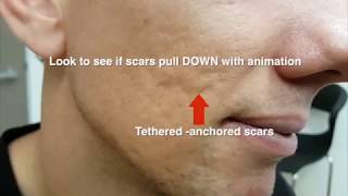 ACNE SCARS  subcision [upl. by Zonnya]