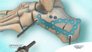 Wright  Ortholoc Calcaneal Fracture system [upl. by Hinkle515]