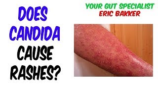 Can a Candida Cleanse Cause a Skin Rash [upl. by Olwen826]