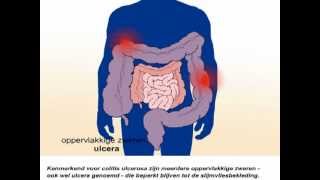 Colitis ulcerosa  Wat zijn de symptomen [upl. by Nylinej976]