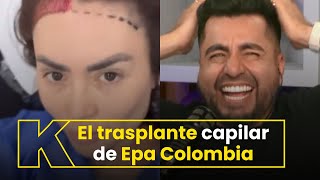 Epa Colombia mostró los detalles del trasplante capilar que se realizó [upl. by Ennadroj]