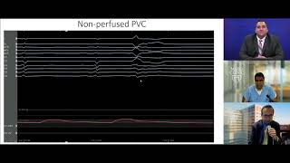 Complex PVC Ablation  Tips and Tricks for Success [upl. by Helga516]