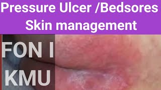 Bedsores  pressure ulcer skin management FON l KMU new 2024 [upl. by Madaras]