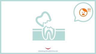 Denti che si rompono in seguito a devitalizzazione [upl. by Aisela]