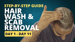 StepbyStep Guide How to Wash Your Hair and Remove Scabs after a Hair Transplant Day 1 to 11 [upl. by Sabrina]