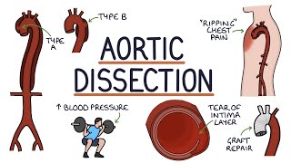 Understanding Aortic Dissection [upl. by Nnauol370]