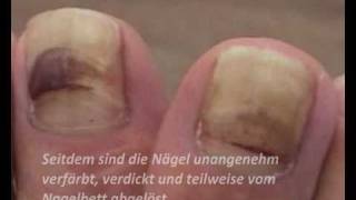 Nagelpilz Folgen sind gelbe dicke Fußnägel Was tun Das spezielle Fußnagel Spray [upl. by Enetsirhc]