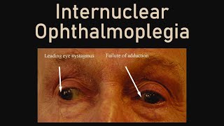 Internuclear Ophthalmoplegia [upl. by Aihsel]