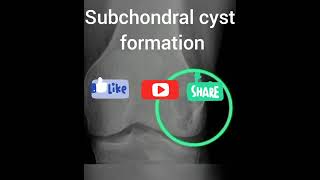 Osteoarthritis OA of knee xray findings tamil xray physiotherapy physicaltherapy [upl. by Adehsar]