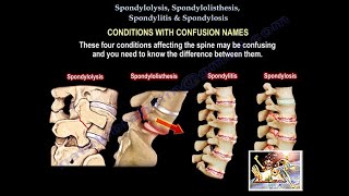 Spondylolysis Spondylolisthesis Spondylitis SpondylosisEverything Need To KnowDr Nabil Ebraheim [upl. by Donielle]