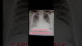 Cardiomegaly and chronic bronchitis shortvideo [upl. by Junette]