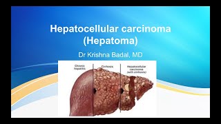 Hepatocellular carcinoma [upl. by Winslow482]