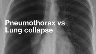 Pneumothorax vs Lung Collapse [upl. by Besse]