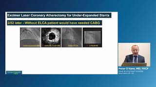 Role of laser atherectomy in coronary in stent re stenosis ISR [upl. by Luhem667]