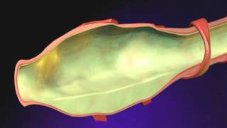 Bronchiectasis Animation  What is Bronchiectasis Videomp4 [upl. by Anilorak]