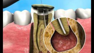 Treatment of Apical Periodontitis  a new approach [upl. by Uuge]