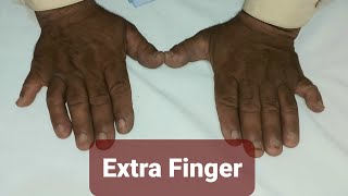 Polydactylism  Extra Fingers [upl. by Purington]