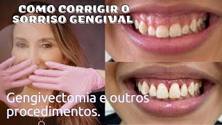 Tratamento para o Sorriso Gengival Gengivectomia Gengivoplastia Aumento de Coroa Clínica Botox [upl. by Harley]