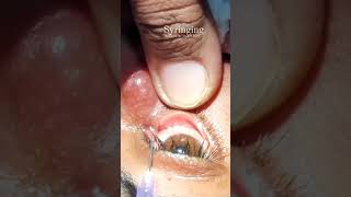 Srynging to check the nasolacrimal duct obstruction dacryocystitis optometry shortvideo [upl. by Bourque]