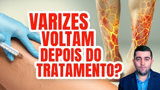 Varizes Diga Adeus com o Tratamento Certo Laser Cirurgia Aplicação ou Espuma Densa Qual melhor [upl. by Nikaniki163]