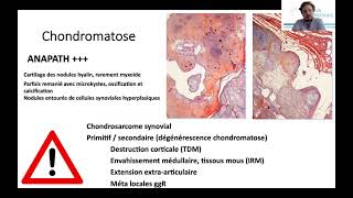 Pathologie de la Membrane synoviale du genou [upl. by Nillek]