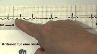 EKG für Pflege Teil 13  atemabhängige Sinusarrhythmie interpretieren [upl. by Ylla]