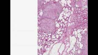 Histopathology Lung Tuberculosis [upl. by Aleahc5]