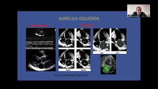 Ecocardiografia en la predicción de embolismo y recurrencia de la FA  Carlos Javier Ramirez [upl. by Saxe]