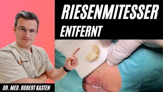 RIESENKOMEDO in der Leiste entfernt Hautarzt kann es kaum fassen Mitesser pimple giant comedone [upl. by Gosselin]