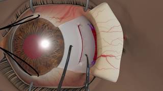 Strabismus surgery Recession [upl. by Yluj]