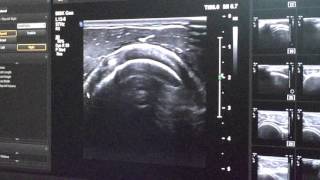 Demo schoudersprotocol echografie [upl. by Lecrad]