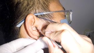 Mans HUGE Earwax Removal  Hes Deaf No More [upl. by Prentice976]