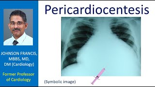 Pericardiocentesis [upl. by Wiersma]