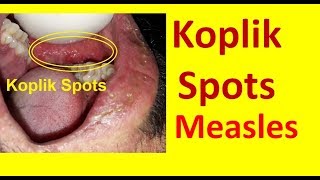 Koplik Spots in Measles [upl. by Sylas]