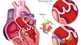 اقوى شرح Endocarditis بالتفصيل 💗🥰💫💯 [upl. by Nylteak388]