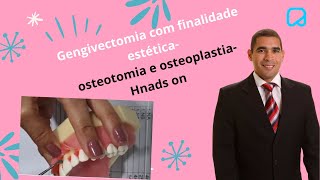 Gengivectomia com finalidade estética osteotomia e osteoplastiaHnads on dralexguedes [upl. by Anehs]