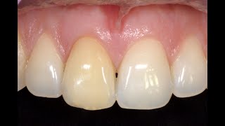 DRendo  Retreatment and endodontic bleaching of a maxillary central incisor [upl. by Emelita886]