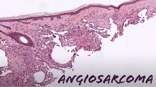 Angiosarcoma under the microscope explained in 5 minutes pathology dermpath dermatology [upl. by Ringo689]