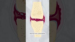 Osteoarthritis vs Osteoporosis [upl. by Aseela]